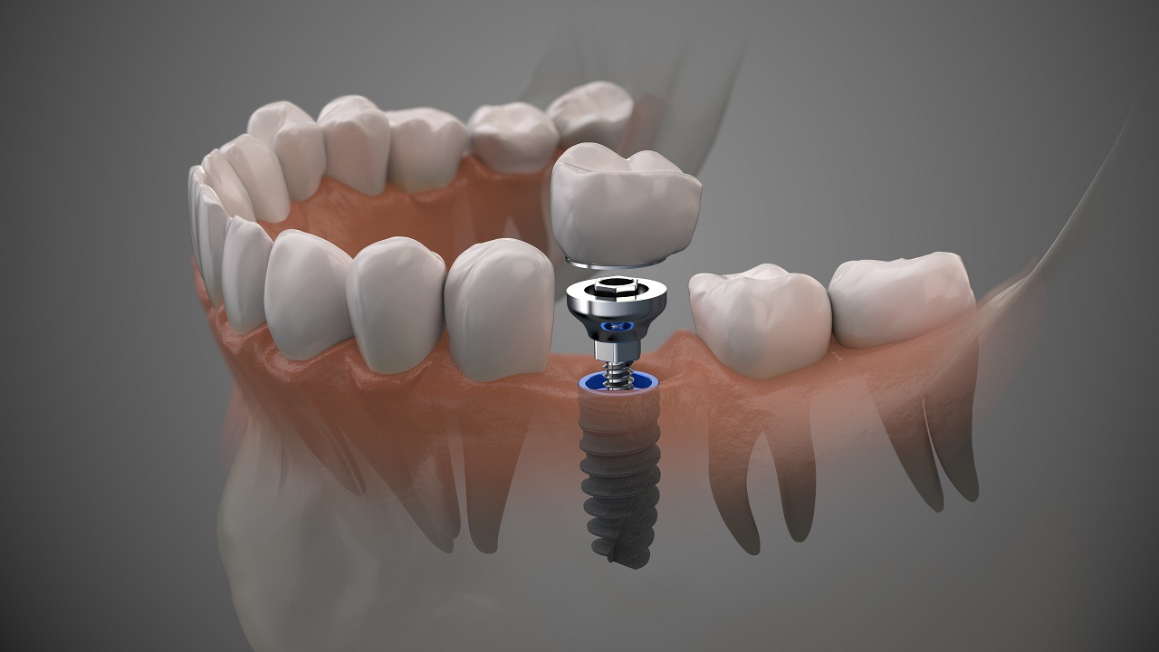 Implanty zębów – jakie mają zalety?